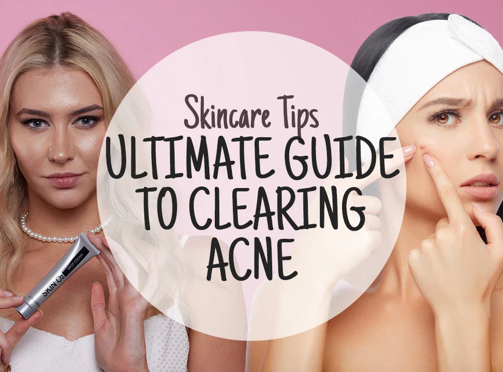 The Ultimate Guide to Clearing Acne
