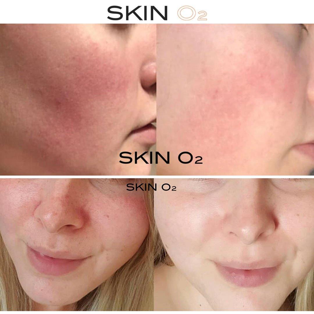 Plus C Serum Kit - Skin O2