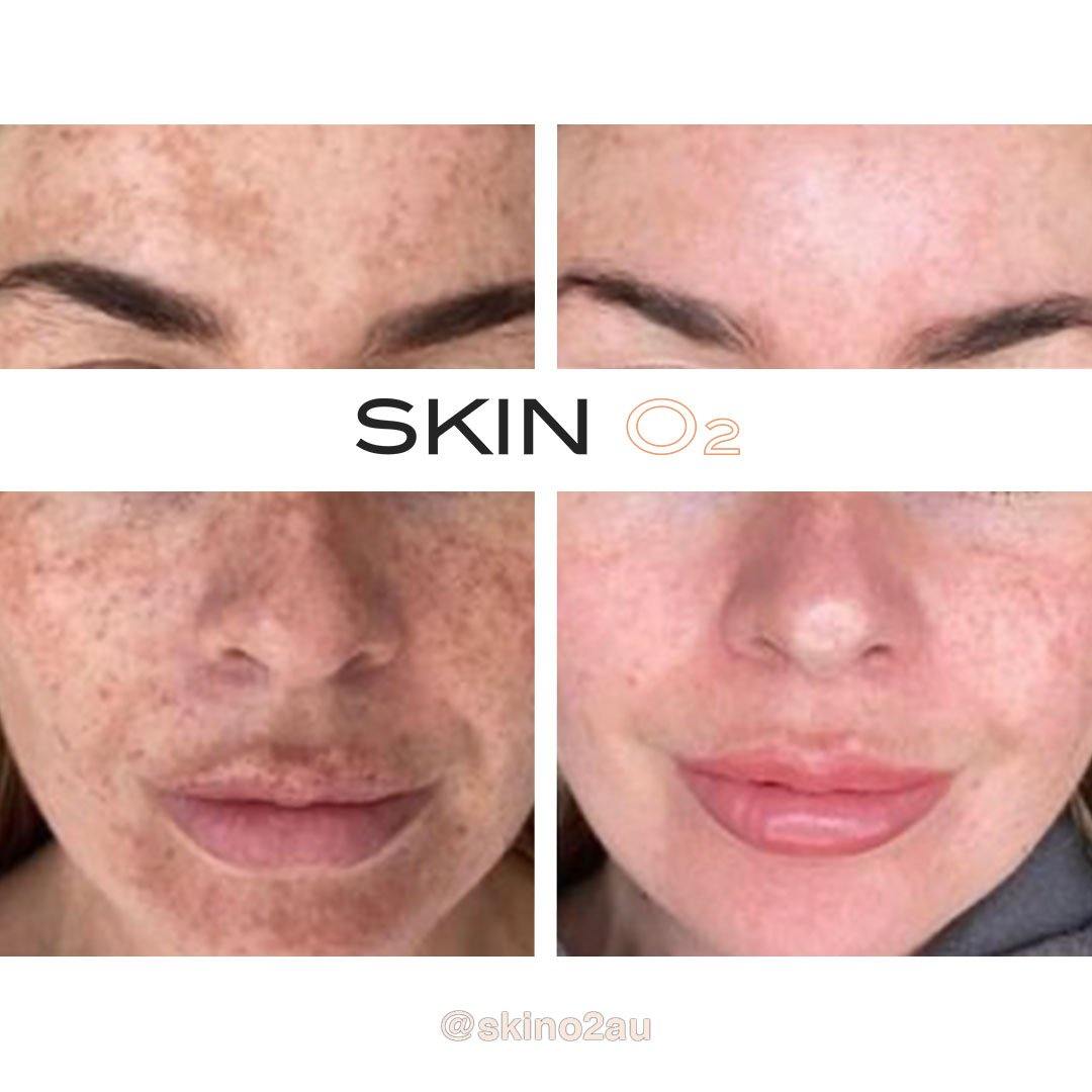 Ultra Glow Serum Kit - Skin O2