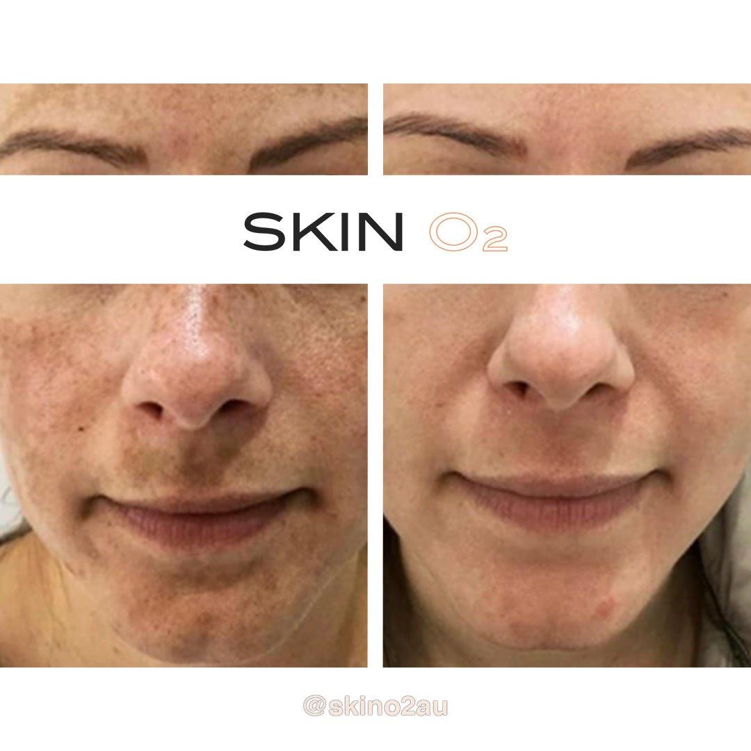 Ultra Glow Serum Kit - Skin O2