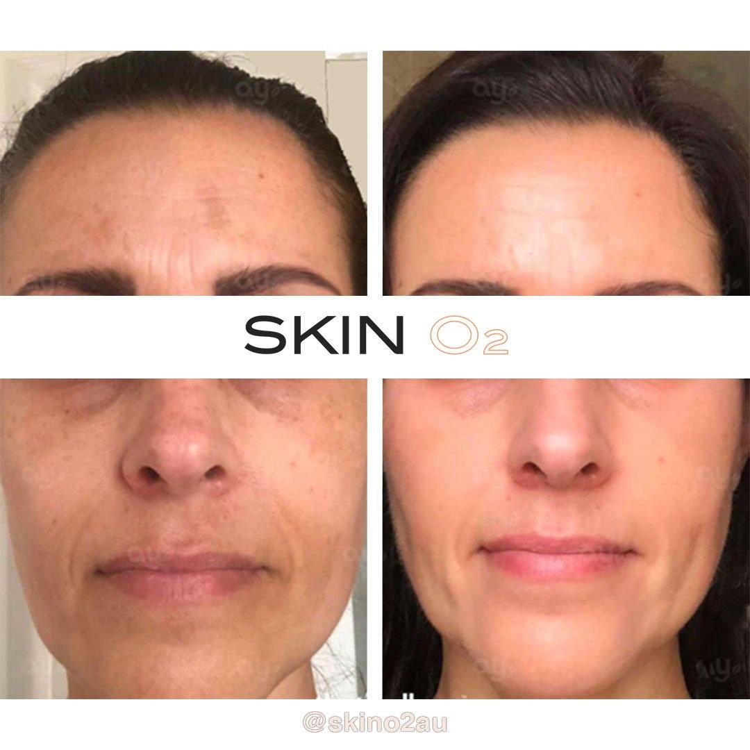 Ultra Glow Serum Kit - Skin O2