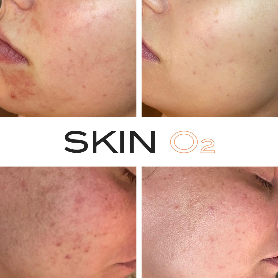 Salicylic Acid Serum